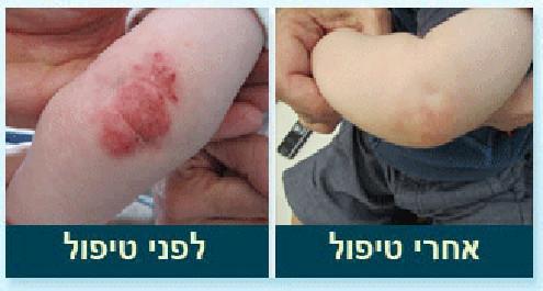 טיפול טבעי באסטמה של העור בילדים