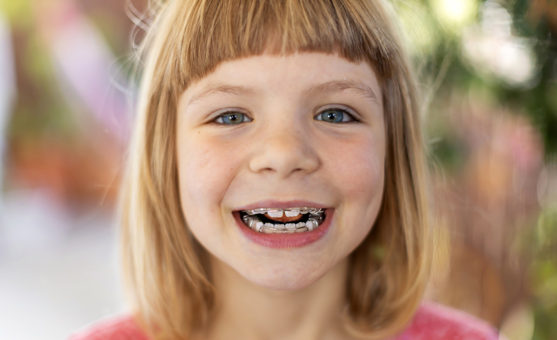 כל מה שחשוב לדעת על יישור שיניים לילדים